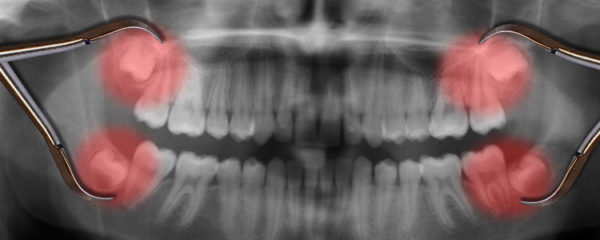 Wisdom Tooth Extraction