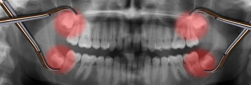 Wisdom Tooth Extraction